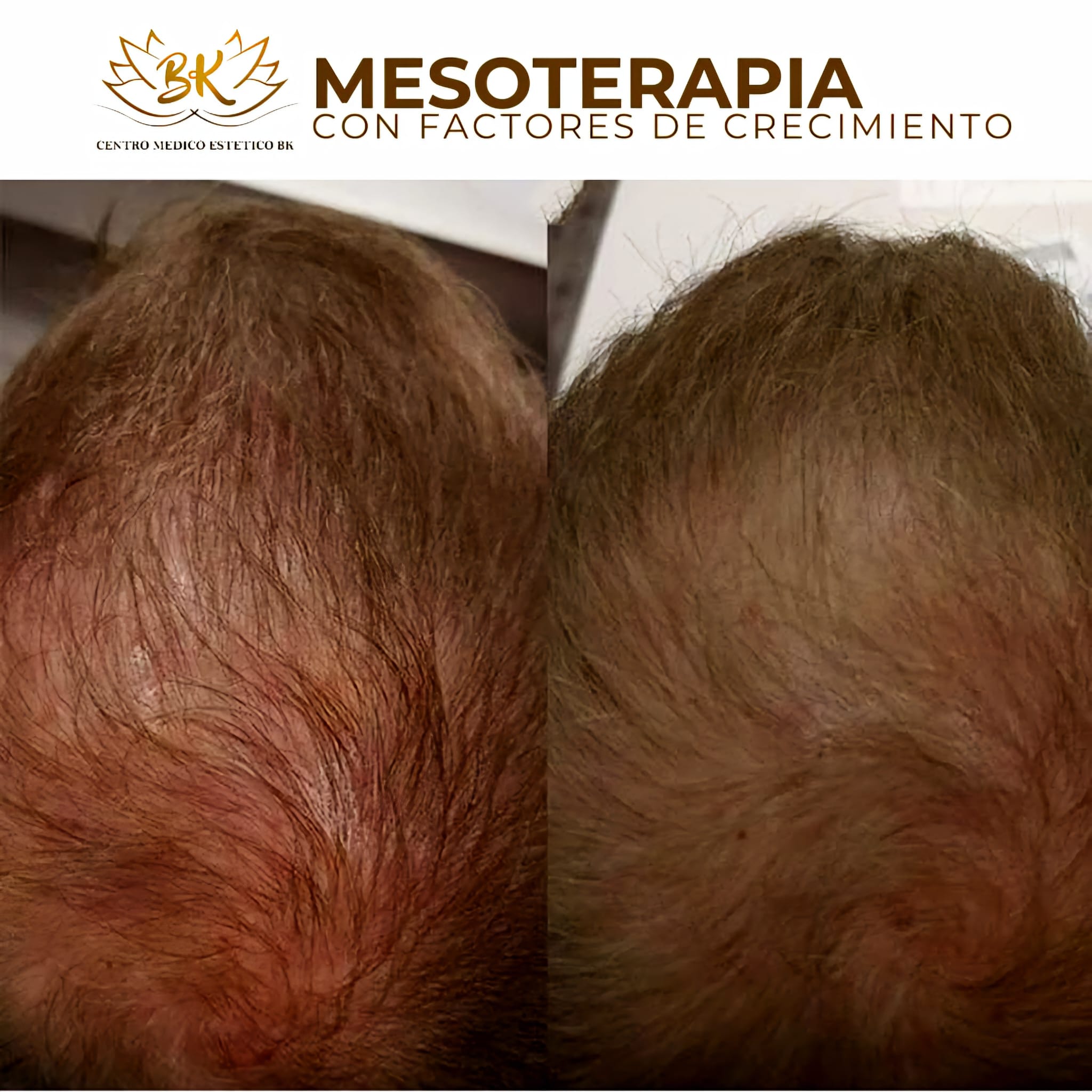 terapia capilar mesoterapia con factores de creciemiento